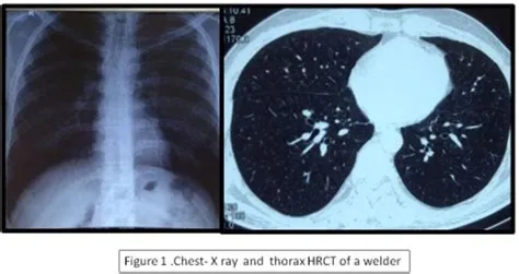 What is welders lung?