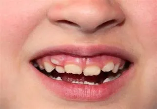 What causes double teeth?