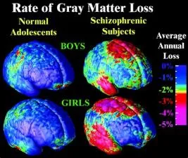 Do we lose grey matter as we age?