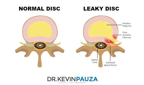 Does a disc leak?