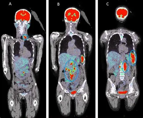 Are pet scans 100 accurate?