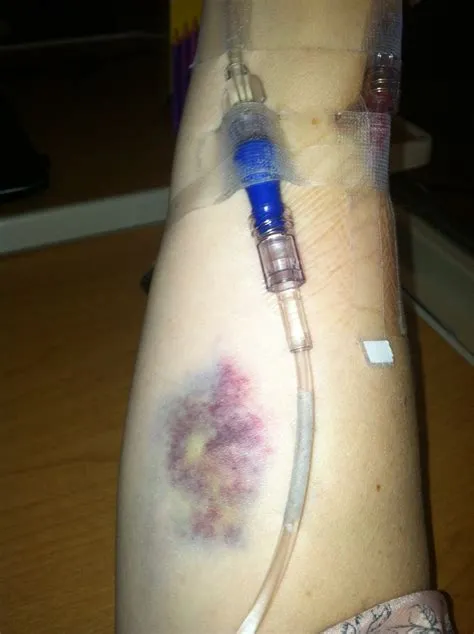 Can ivs go bad?