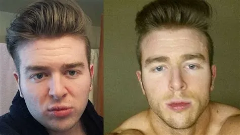 Does face fat ever go away?