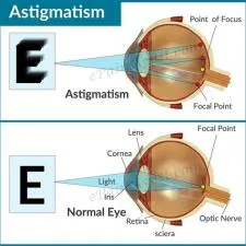 Is 5.25 myopia bad?