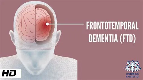 What are the first signs of frontotemporal dementia?