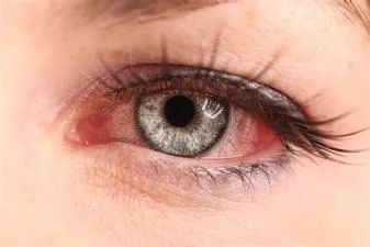 Can vr give you pink eye?